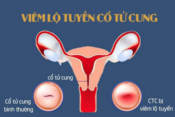 Viêm lộ tuyến cổ tử cung: Các triệu chứng và nguyên nhân nhận biết